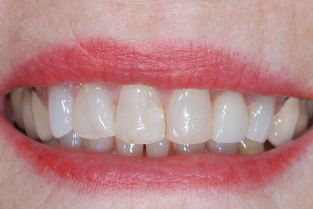 Smile Makeover after Smile Makeover after