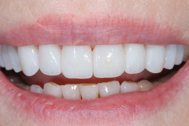 Smile Makeover before